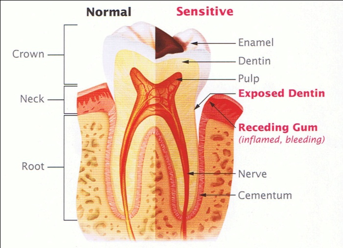 Treatment of Sensitivity